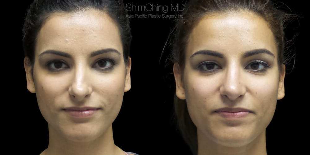 Rhinoplasty Before & After Gallery - Patient 38290640 - Image 3