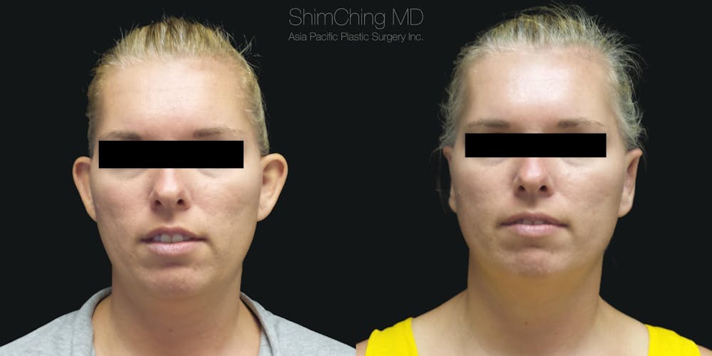 Otoplasty Before & After Gallery - Patient 38290641 - Image 1