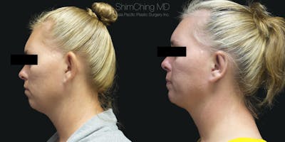 Otoplasty Before & After Gallery - Patient 38290641 - Image 2