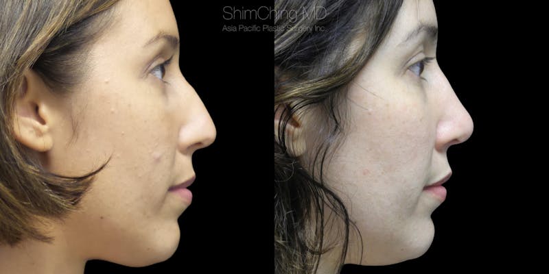 Before and after nose surgery in Honolulu, Hawaii with Dr. Shim Ching