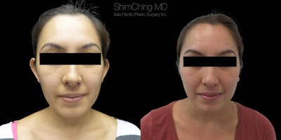 Otoplasty Before & After Gallery - Patient 38290643 - Image 1