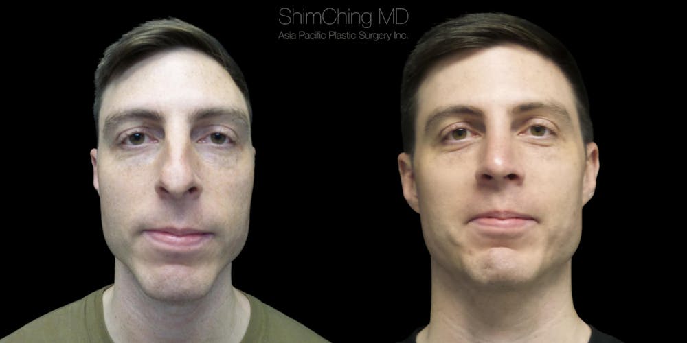 Rhinoplasty Before & After Gallery - Patient 38290645 - Image 2