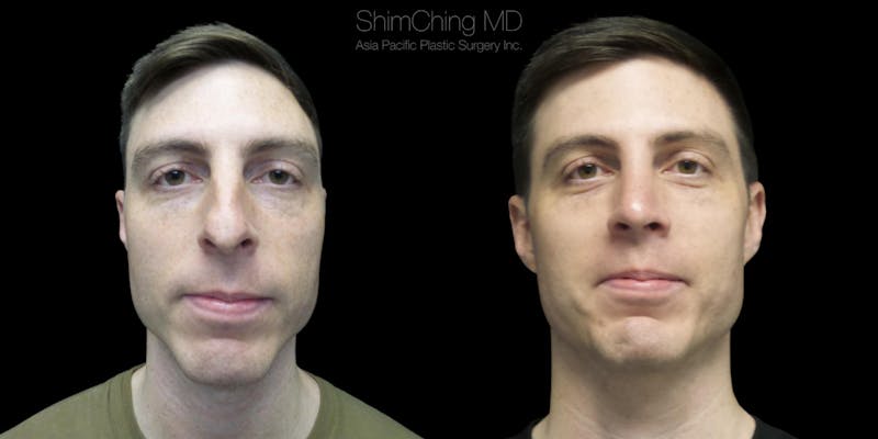 Before and after Rhinoplasty in Hawaii with Dr. Shim Ching