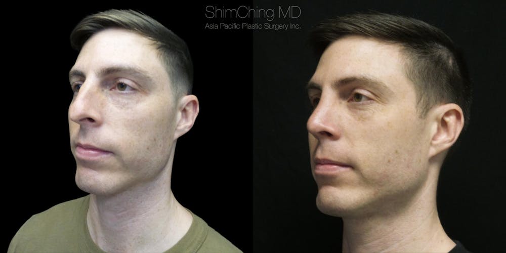 Rhinoplasty Before & After Gallery - Patient 38290645 - Image 1