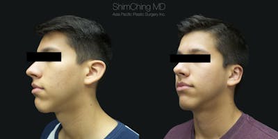 Otoplasty Before & After Gallery - Patient 38290646 - Image 1