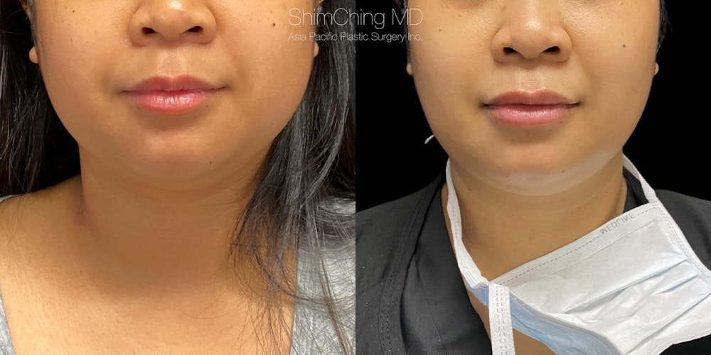 Buccal Fat Removal Before & After Gallery - Patient 38290648 - Image 1