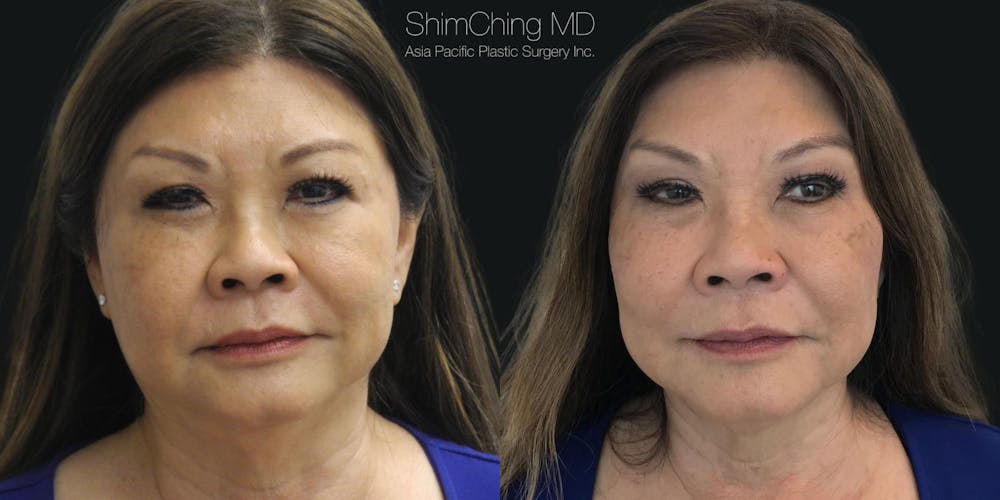 Instalift Before & After Gallery - Patient 38290647 - Image 1
