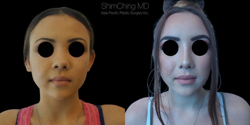 Before and after nose surgery in Hawaii with Dr. Shim Ching
