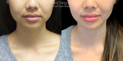 Buccal Fat Removal Before & After Gallery - Patient 38290650 - Image 1