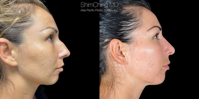 Rhinoplasty Surgery