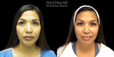 Rhinoplasty Before & After Gallery - Patient 38290653 - Image 2