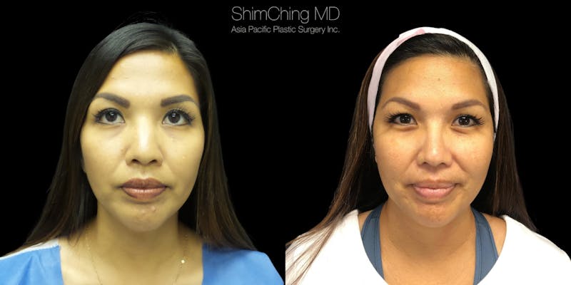 Nose surgery results in Honolulu, Hawaii with Dr. Shim Ching