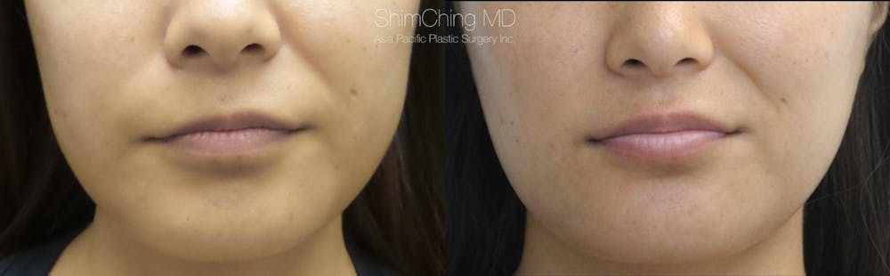 Buccal Fat Removal Before & After Gallery - Patient 38290654 - Image 1