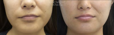 Buccal Fat Removal Before & After Gallery - Patient 38290654 - Image 1