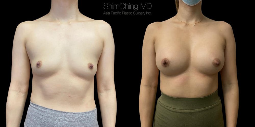 Breast Augmentation Before & After Gallery - Patient 38290657 - Image 1