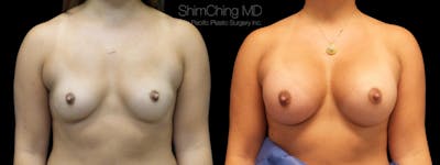 Breast Augmentation Before & After Gallery - Patient 38290660 - Image 1