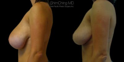Breast Lift Before & After Gallery - Patient 38290663 - Image 2