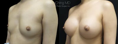 Breast Augmentation Before & After Gallery - Patient 38290662 - Image 1