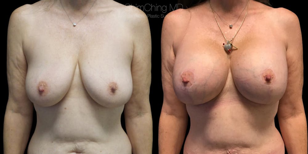 Breast Lift with Implants Before & After Gallery - Patient 38290664 - Image 1