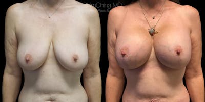 Breast Lift with Implants Before & After Gallery - Patient 38290664 - Image 1