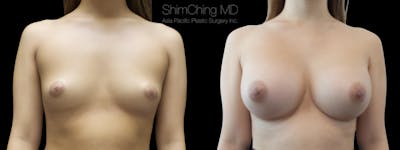 Breast Augmentation Before & After Gallery - Patient 38290665 - Image 1