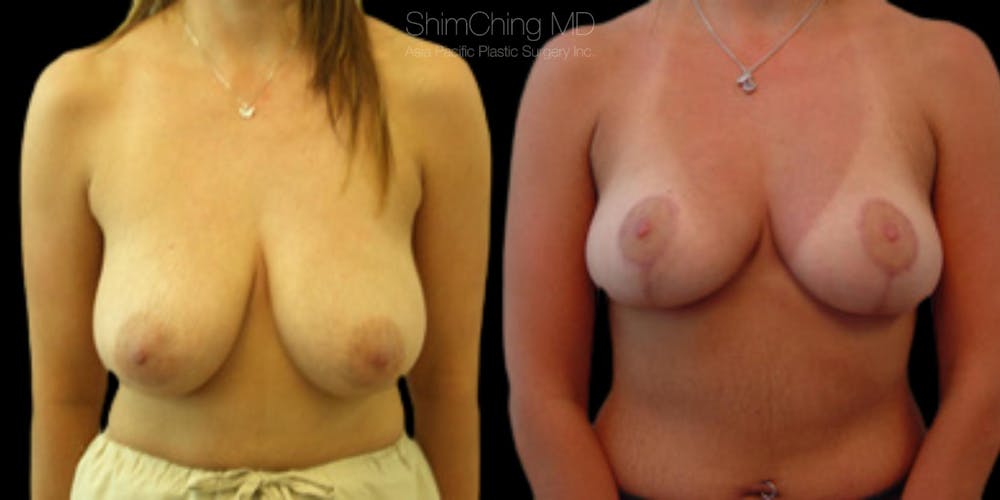 Breast Reduction Before & After Gallery - Patient 177777143 - Image 1