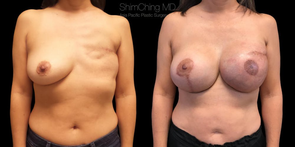 Breast Reconstruction Before & After Gallery - Patient 38290669 - Image 1