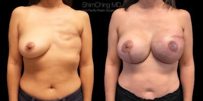Breast Reconstruction Before & After Gallery - Patient 38290669 - Image 1