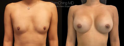 Breast Augmentation Before & After Gallery - Patient 38290670 - Image 1