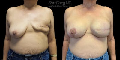 Breast Reconstruction Before & After Gallery - Patient 38290671 - Image 1
