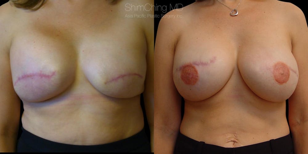 Breast Reconstruction Before & After Gallery - Patient 38290673 - Image 1