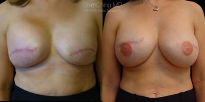 Breast Reconstruction Before & After Gallery - Patient 38290673 - Image 1
