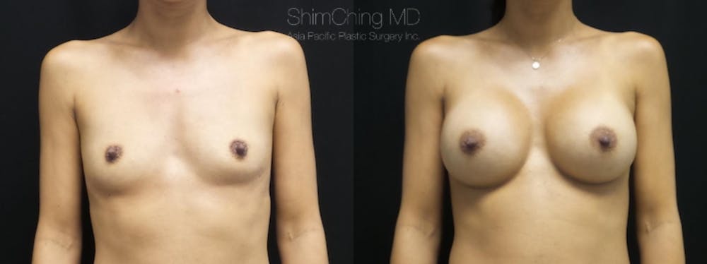 Breast Augmentation Before & After Gallery - Patient 38290674 - Image 1