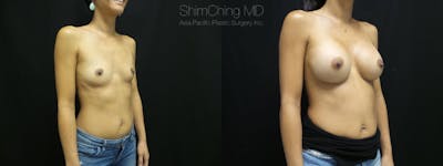 Breast Augmentation Before & After Gallery - Patient 38290674 - Image 2