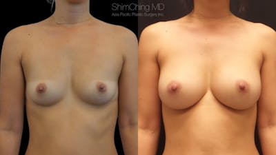Breast Augmentation Before & After Gallery - Patient 38290676 - Image 1