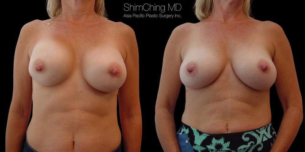 Breast Augmentation Revision Before & After Gallery - Patient 38290677 - Image 1
