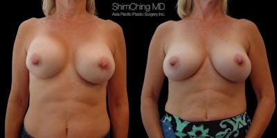 Breast Augmentation Revision Before & After Gallery - Patient 38290677 - Image 1
