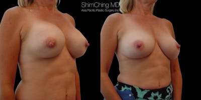 Breast Augmentation Revision Before & After Gallery - Patient 38290677 - Image 2