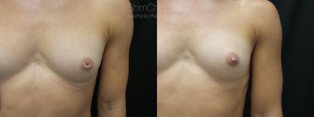 Inverted Nipple Correction Before & After Gallery - Patient 38290682 - Image 1