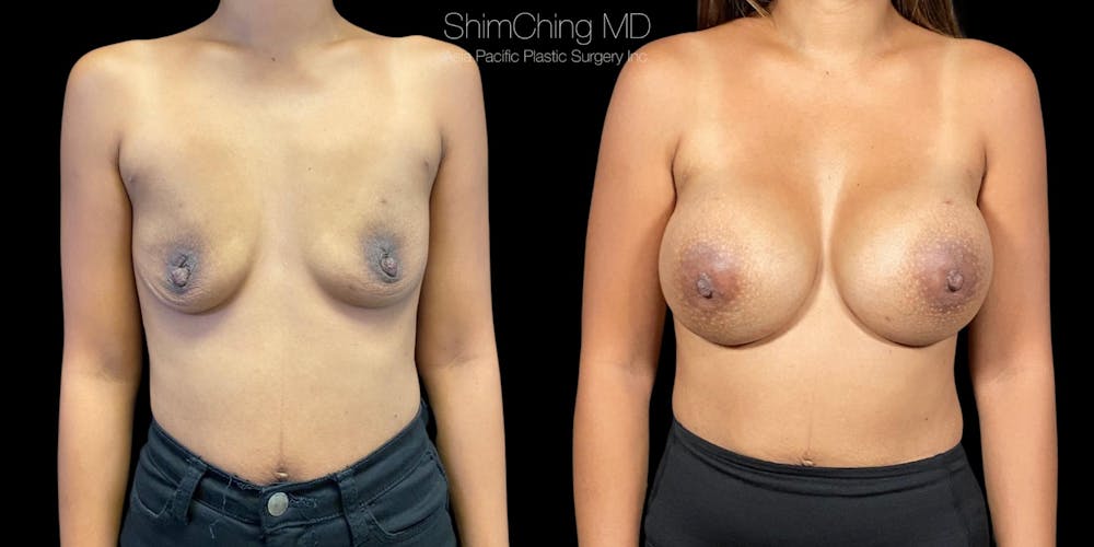 Breast Augmentation Before & After Gallery - Patient 38290680 - Image 1