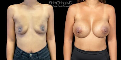 Breast Augmentation Before & After Gallery - Patient 38290680 - Image 1