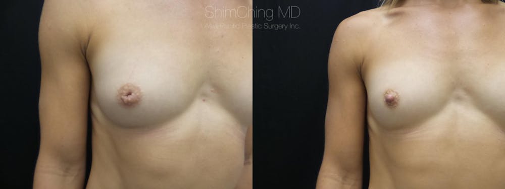 Inverted Nipple Correction Before & After Gallery - Patient 38290682 - Image 2