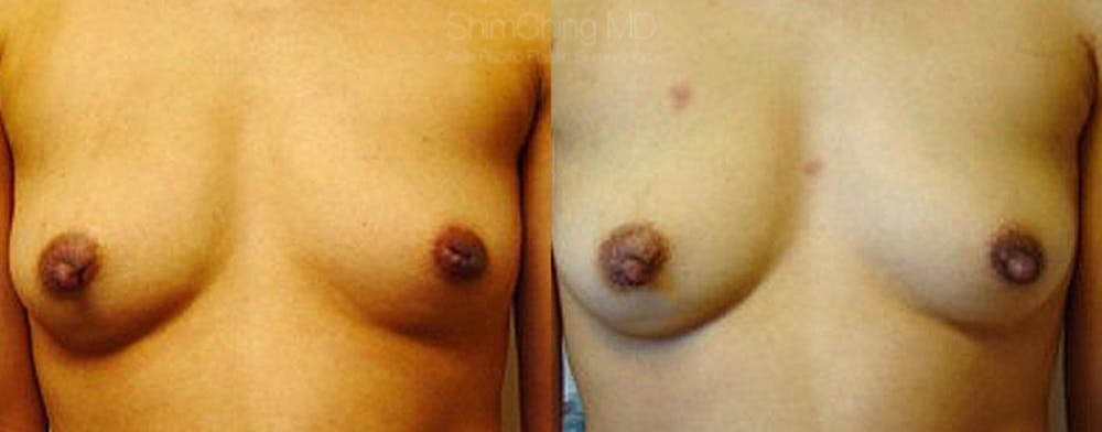 Inverted Nipple Correction Gallery - Patient 38290684 - Image 1