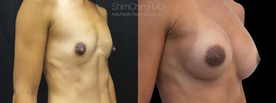 Nipple Reduction Before & After Gallery - Patient 38290695 - Image 1