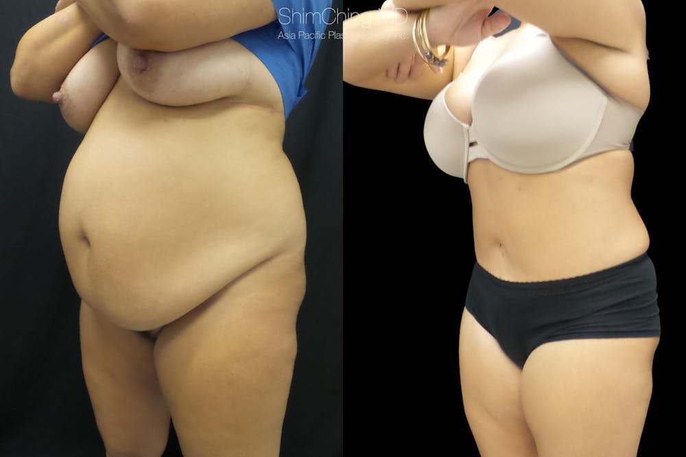 Tummy Tuck Before & After Gallery - Patient 38298968 - Image 1