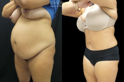 Tummy Tuck Before & After Gallery - Patient 38298968 - Image 1