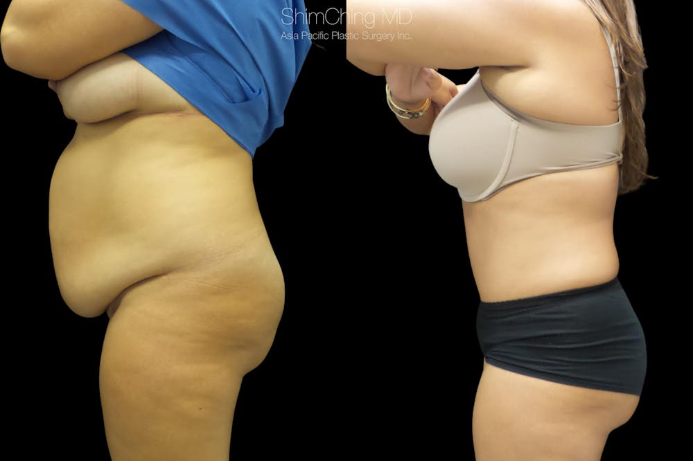 Tummy Tuck Before & After Gallery - Patient 38298968 - Image 2