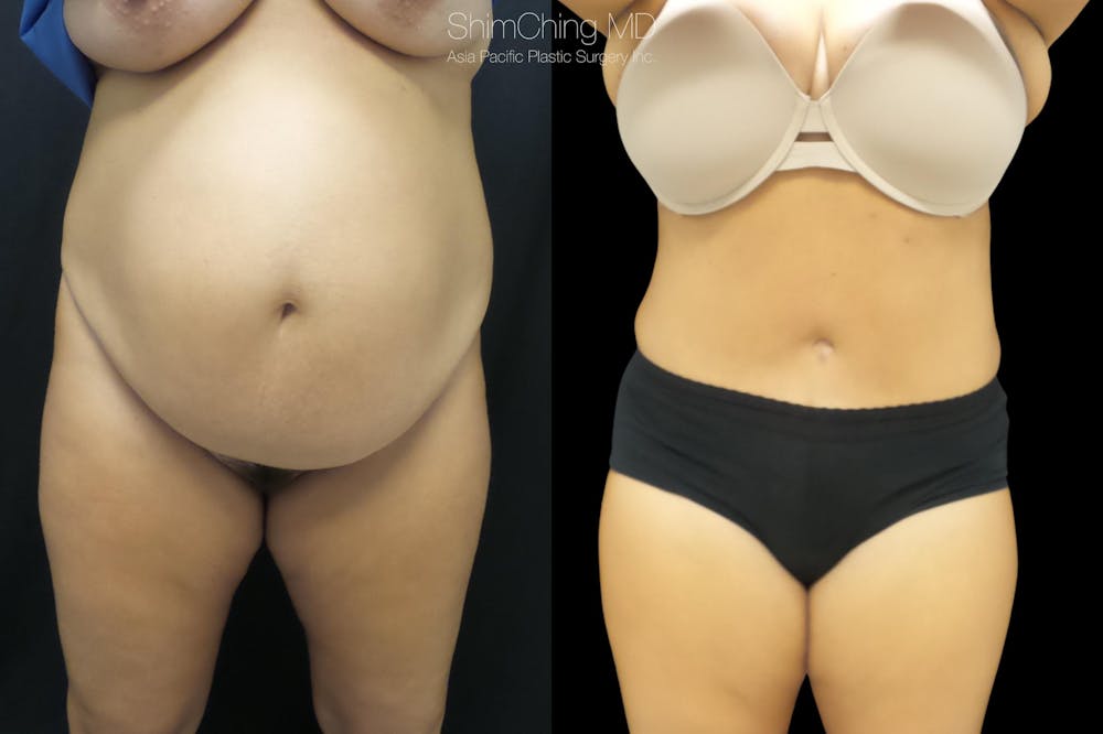 Tummy Tuck Before & After Gallery - Patient 38298968 - Image 3