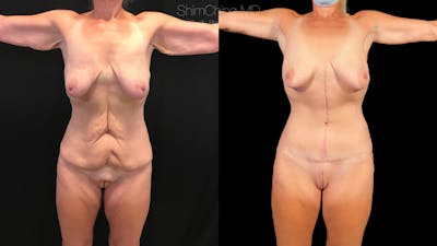 Arm Lift Before & After Gallery - Patient 38298971 - Image 1