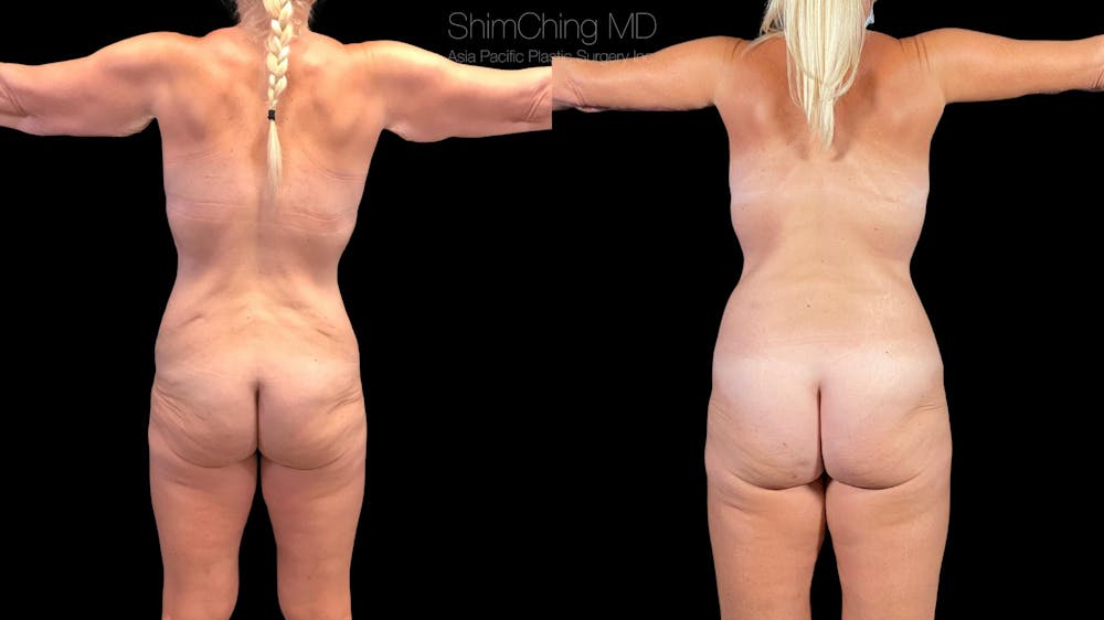 Arm Lift Before & After Gallery - Patient 38298971 - Image 3